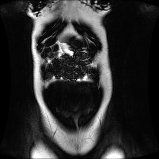 Normal MRI abdomen in pregnancy (Radiopaedia 88001-104541 N 32).jpg