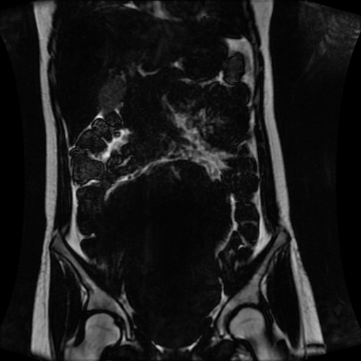 Normal MRI abdomen in pregnancy (Radiopaedia 88001-104541 N 64).jpg