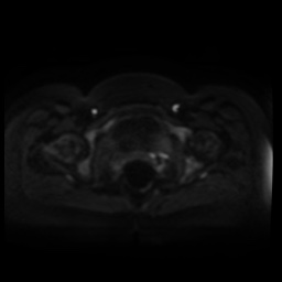Normal MRI abdomen in pregnancy (Radiopaedia 88005-104548 Axial DWI 82).jpg