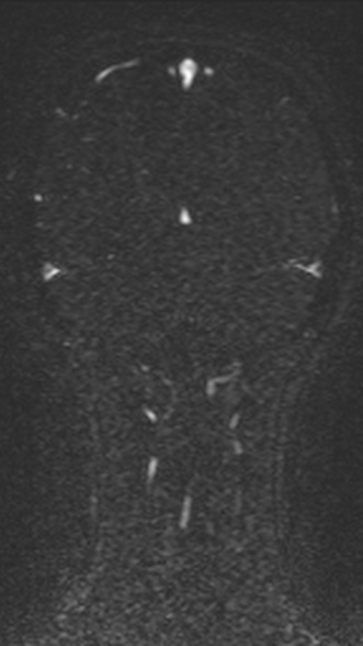 Normal MRI brain with MRV- teenager (Radiopaedia 49425-54553 Coronal MRV 189).jpg