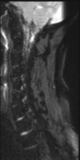 File:Normal MRI cervical spine (infection protocol) (Radiopaedia 53916-60039 Sagittal DWI 9).png
