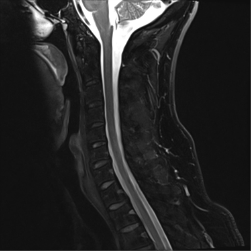 File:Normal MRI cervical spine (infection protocol) (Radiopaedia 53916-60039 Sagittal Dixon 9).png