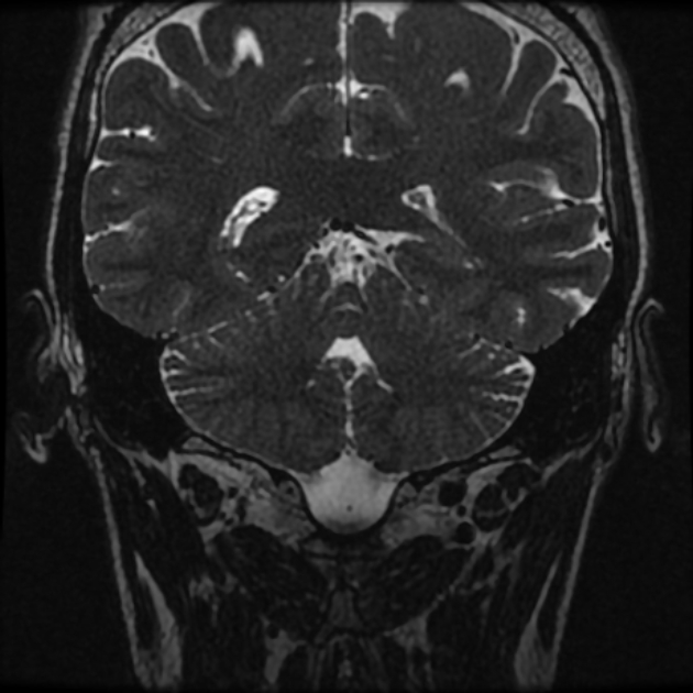 Normal MRI petrous (Radiopaedia 91317-108949 Coronal T2 89).jpg