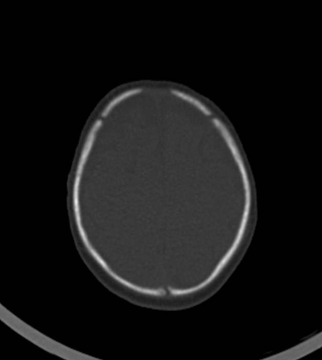 Normal brain CT - 2-month-old (Radiopaedia 53369-59350 Axial bone window 11).jpg