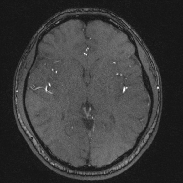 Normal brain MRI including MRA (Radiopaedia 48748-53763 Axial MRA 114).jpg