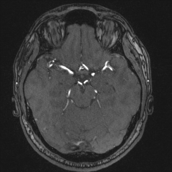 Normal brain MRI including MRA (Radiopaedia 48748-53763 Axial MRA 80).jpg