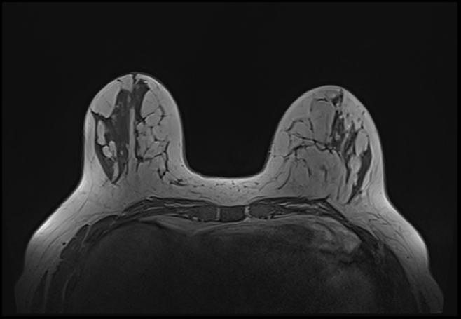 File:Normal breast MRI - dense breasts (Radiopaedia 80454-93850 Axial T1 72).jpg