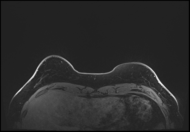 Normal breast MRI - dense breasts (Radiopaedia 80454-93850 C 23).jpg