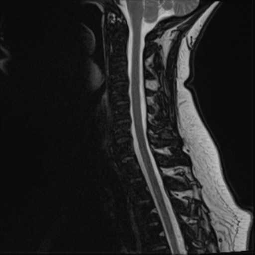 File:Normal cervical spine MRI (including Dixon) (Radiopaedia 42762-45925 Dixon- opposed phase 9).png