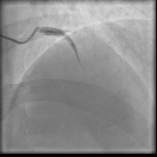 Normal coronary angiogram (DSA) (Radiopaedia 63081-71571 E 16).jpg