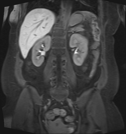 File:Normal hepatobiliary phase liver MRI (Radiopaedia 58968-66230 B 18).jpg