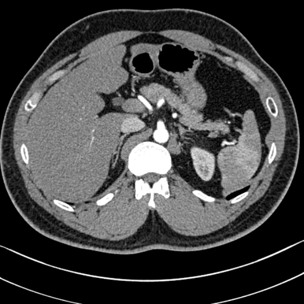Normal kidneys on 4-phase CT study (Radiopaedia 25889-26038 B 7).jpg