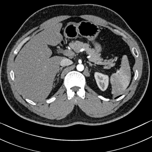 Normal kidneys on 4-phase CT study (Radiopaedia 25889-26038 B 9).jpg