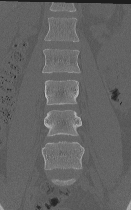 Normal lumbar spine CT (Radiopaedia 46533-50986 Coronal bone window 30).png