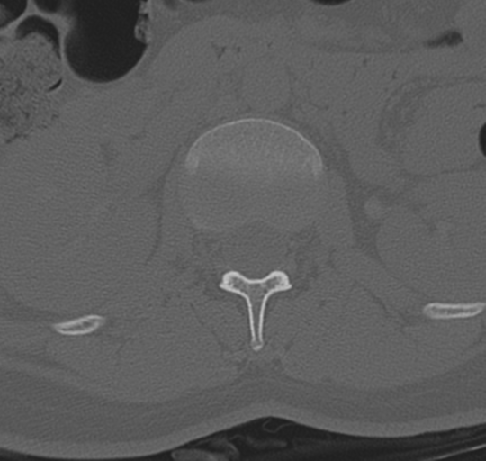 File:Normal lumbosacral CT (Radiopaedia 37923-39867 Axial bone window 35).png