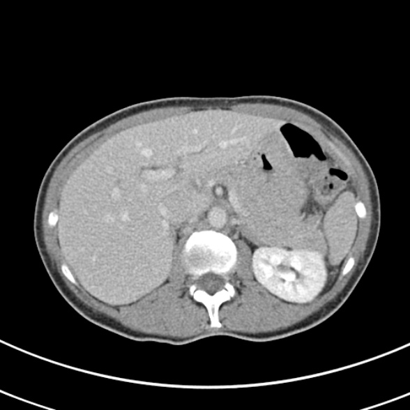 File:Normal multiphase CT liver (Radiopaedia 38026-39996 C 22).jpg