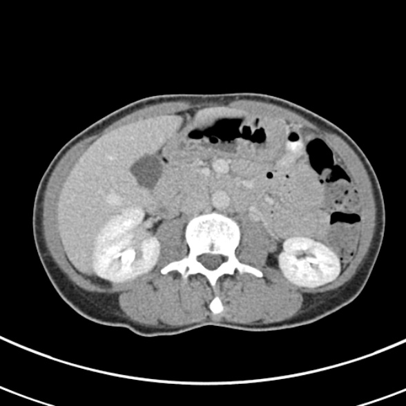 File:Normal multiphase CT liver (Radiopaedia 38026-39996 C 38).jpg