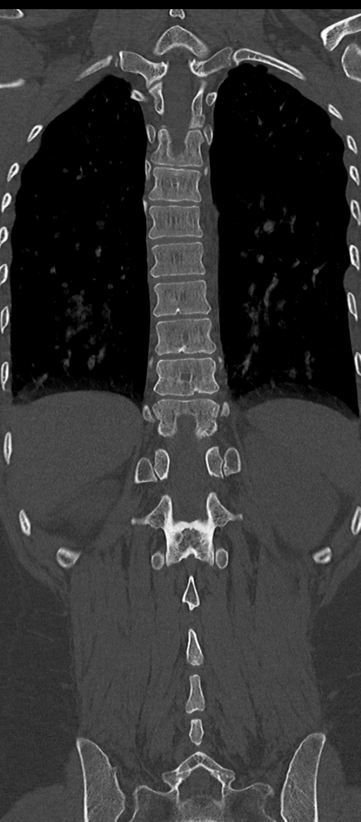 Normal thoracolumbar spine (Radiopaedia 43822-47309 Coronal bone window 63).png
