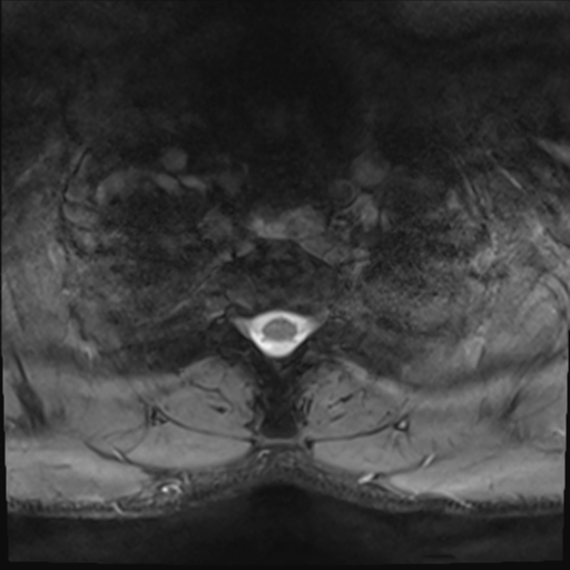 File:Normal trauma cervical spine (Radiopaedia 41017-43762 Axial T2 30).png