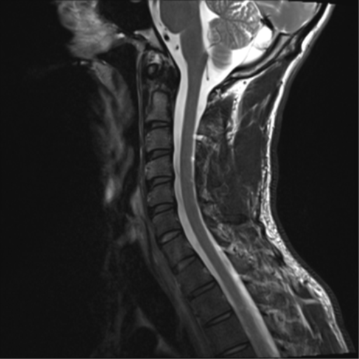 File:Normal trauma cervical spine (Radiopaedia 41017-43762 Sagittal T2 7).png