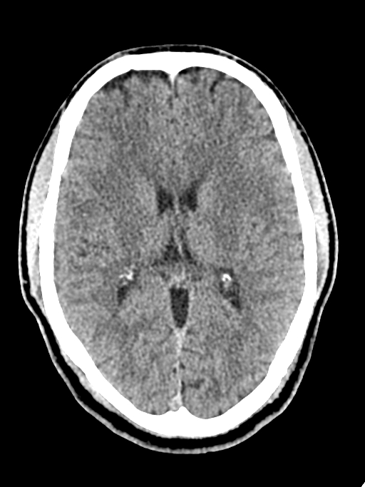 Normal trauma protocol brain and C-spine CT (Radiopaedia 83302-97709 Axial non-contrast 36).jpg