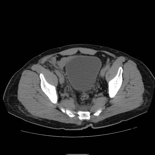 File:Obstructed kidney with perinephric urinoma (Radiopaedia 26889-27066 Axial non-contrast 57).jpg
