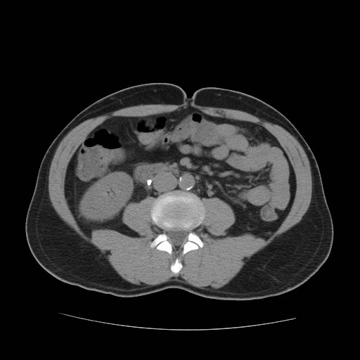 File:Obstructed kidney with perinephric urinoma (Radiopaedia 26889-27067 Axial non-contrast 20).jpg