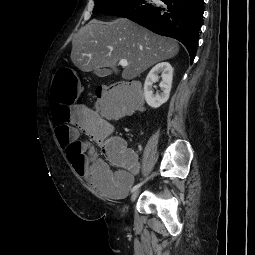 Obstructive colonic diverticular stricture (Radiopaedia 81085-94675 C 93).jpg