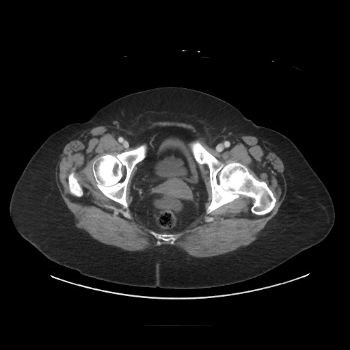 Obstructive distal colonic adenocarcinoma causing cecal perforation (Radiopaedia 86830-102989 A 182).jpg