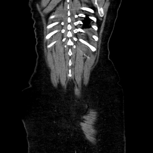 Obstructive distal colonic adenocarcinoma causing cecal perforation (Radiopaedia 86830-102989 C 150).jpg