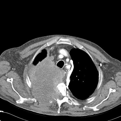 File:Obstructive superior vena cava tumor thrombus (Radiopaedia 28046-28306 A 12).jpg