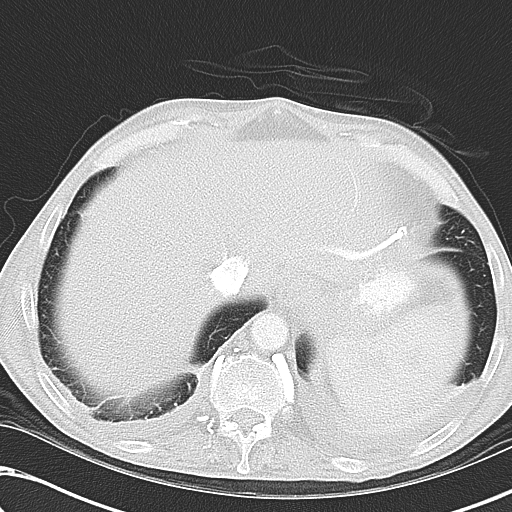 File:Obstructive superior vena cava tumor thrombus (Radiopaedia 28046-28306 Axial lung window 47).jpg