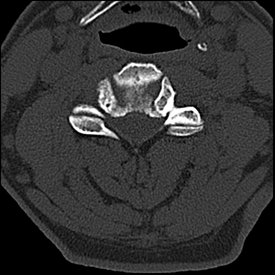 Occipital condyle fracture (type 1) (Radiopaedia 87670-104084 Axial bone window 44).jpg