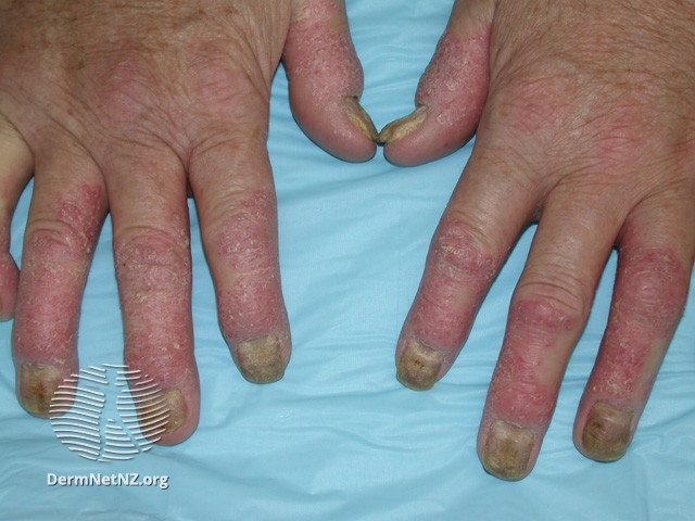 File:Psoriatic arthritis (DermNet NZ scaly-ps-arth1).jpg