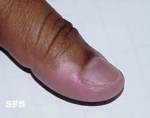 File:Vitiligo (Dermatology Atlas 6).jpg