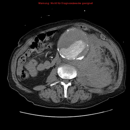 Abdominal aortic aneurysm- extremely large, ruptured (Radiopaedia 19882-19921 Axial C+ arterial phase 38).jpg