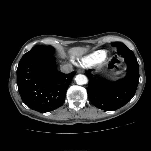 Abdominal aortic aneurysm (Radiopaedia 13341-13340 Axial C+ arterial phase 10).jpg