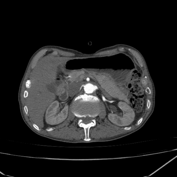 Abdominal aortic aneurysm (Radiopaedia 23703-23856 Axial C+ arterial phase 22).jpg