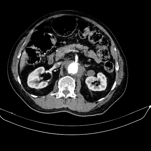 Abdominal aortic aneurysm (Radiopaedia 67117-76452 Axial C+ arterial phase 54).jpg