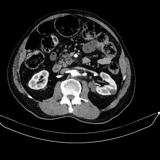 Abdominal aortic aneurysm (Radiopaedia 67117-76452 Axial C+ arterial phase 61).jpg