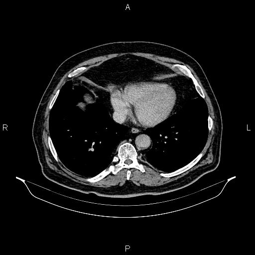 Abdominal aortic aneurysm (Radiopaedia 83094-97462 Axial renal excretory phase 8).jpg