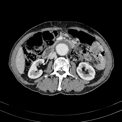 Abdominal aortic aneurysm (Radiopaedia 83581-98689 Axial C+ portal venous phase 54).jpg