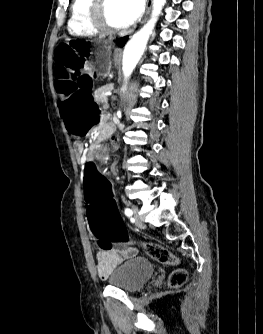 Abdominal aortic aneurysm (Radiopaedia 83581-98689 Sagittal C+ arterial phase 62).jpg