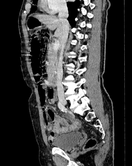 Abdominal aortic aneurysm (Radiopaedia 83581-98689 Sagittal C+ portal venous phase 33).jpg