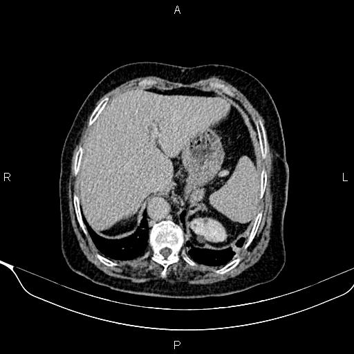 Abdominal aortic aneurysm (Radiopaedia 85063-100606 Axial C+ delayed 6).jpg