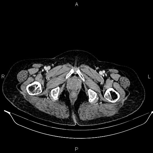 File:Abdominal aortic aneurysm (Radiopaedia 85063-100606 Axial C+ portal venous phase 68).jpg