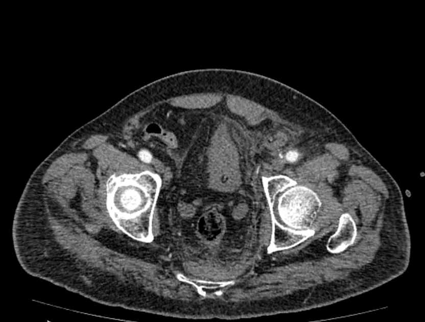 Abdominal aortic aneurysm rupture (Radiopaedia 54179-60362 Axial C+ portal venous phase 2).jpg