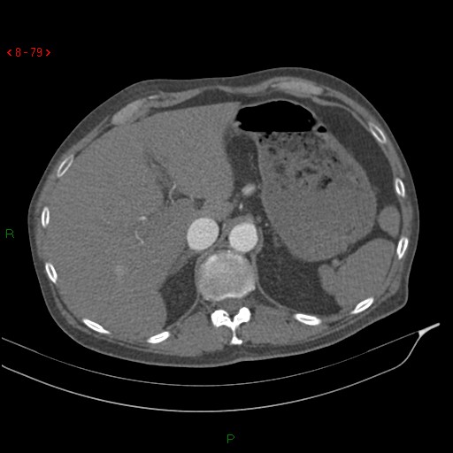 File:Abdominal aortic aneurysm rupture with aortocaval fistula (Radiopaedia 14897-14841 Axial C+ arterial phase 79).jpg