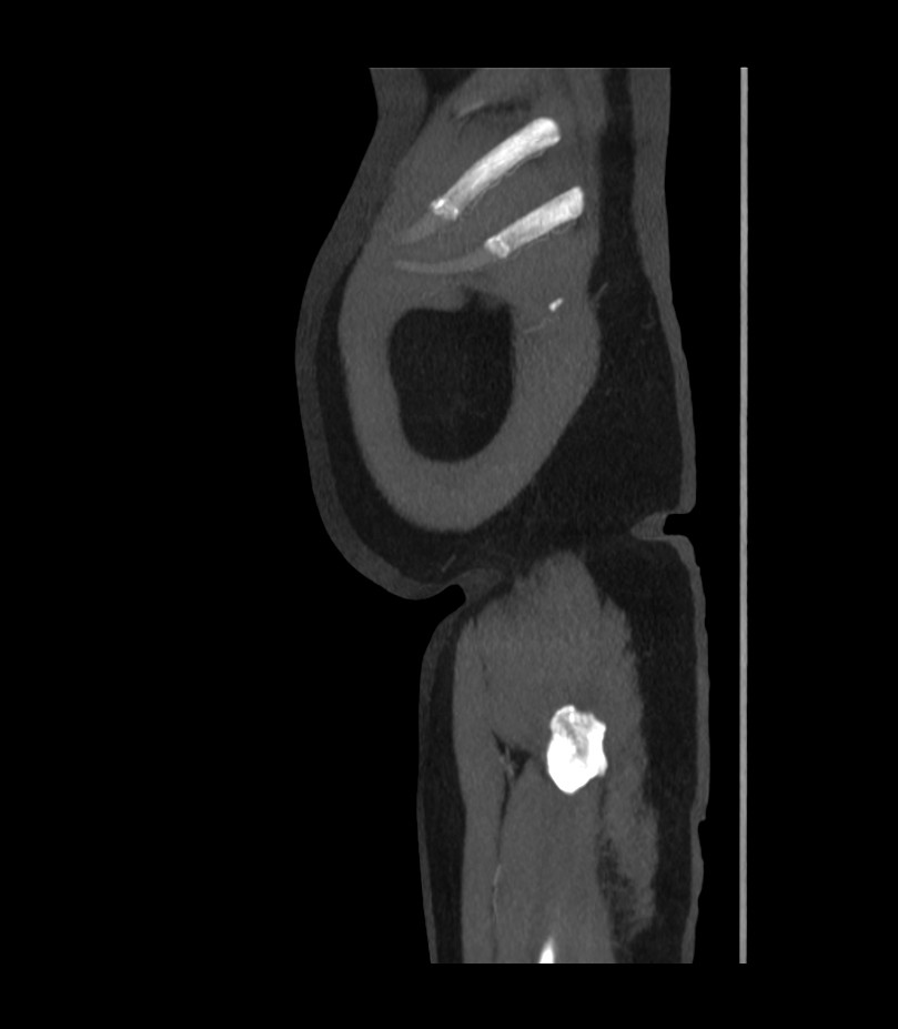 Abdominal aortic aneurysm with thrombus fissuration (Radiopaedia 46218-50618 Sagittal C+ arterial phase 2).jpg
