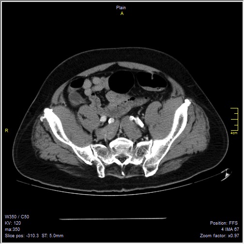 Abdominal aortic aneurysm with thrombus fissuration (Radiopaedia 47340-51926 Axial C+ arterial phase 51).jpg